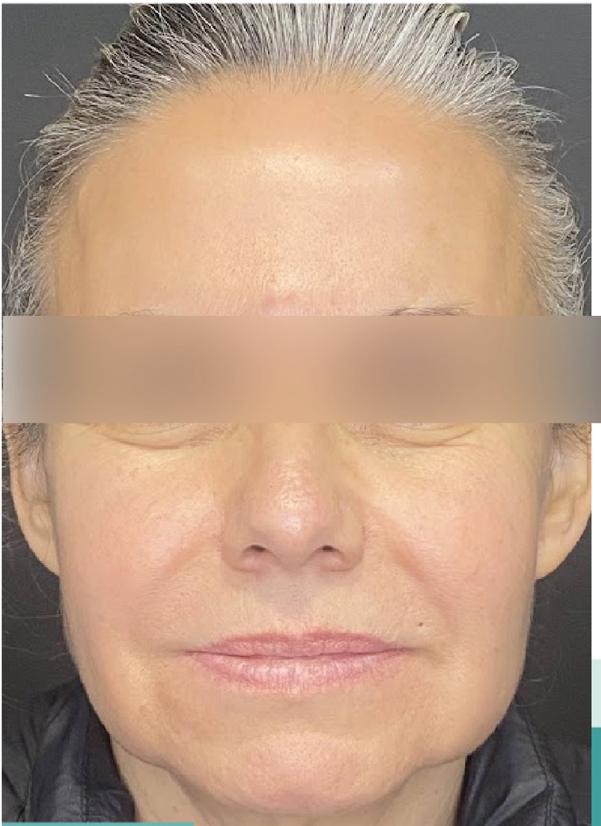 Facelift: before
