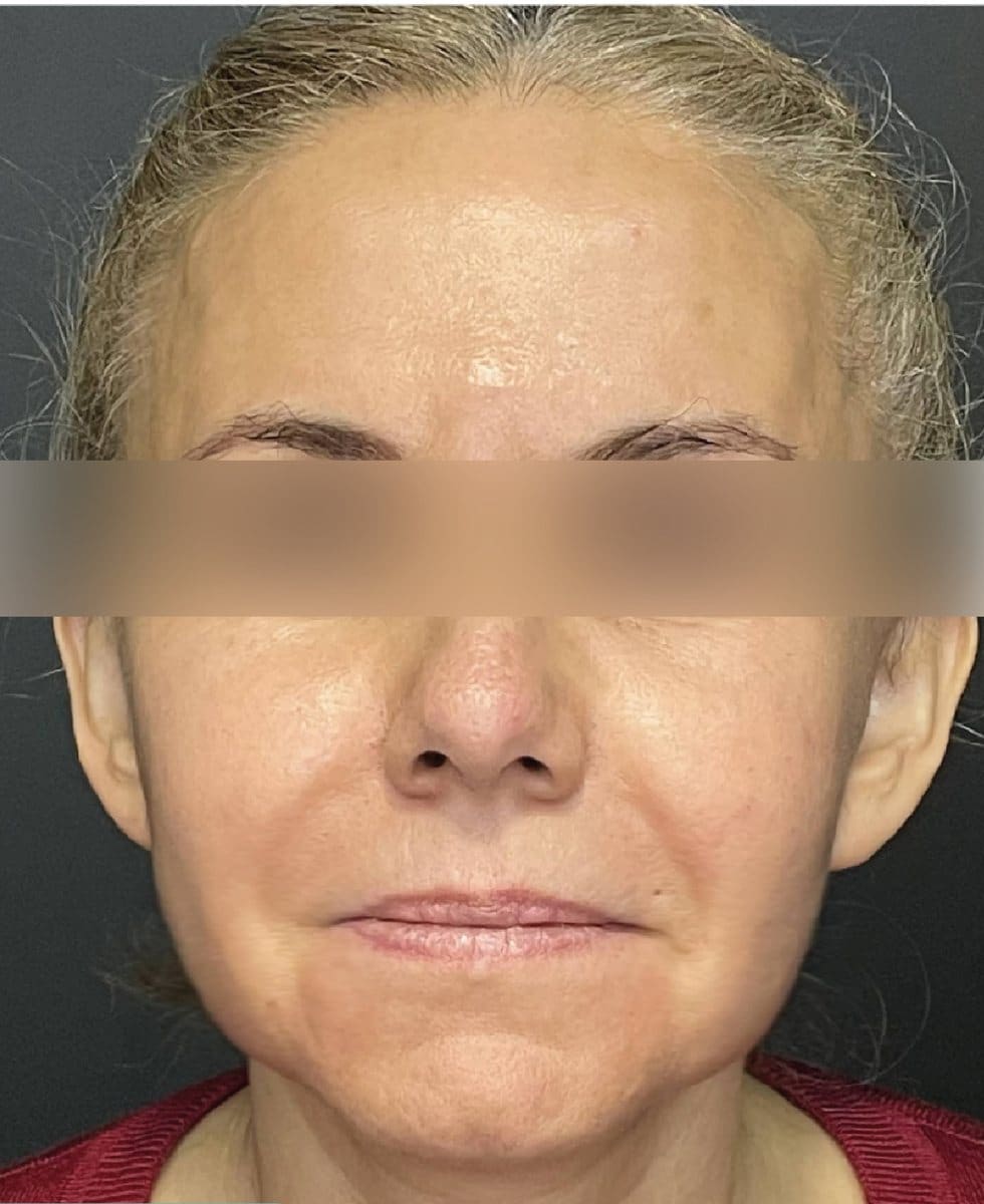 Facelift: after