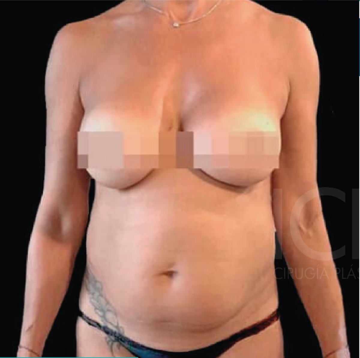 Mommy makeover: before