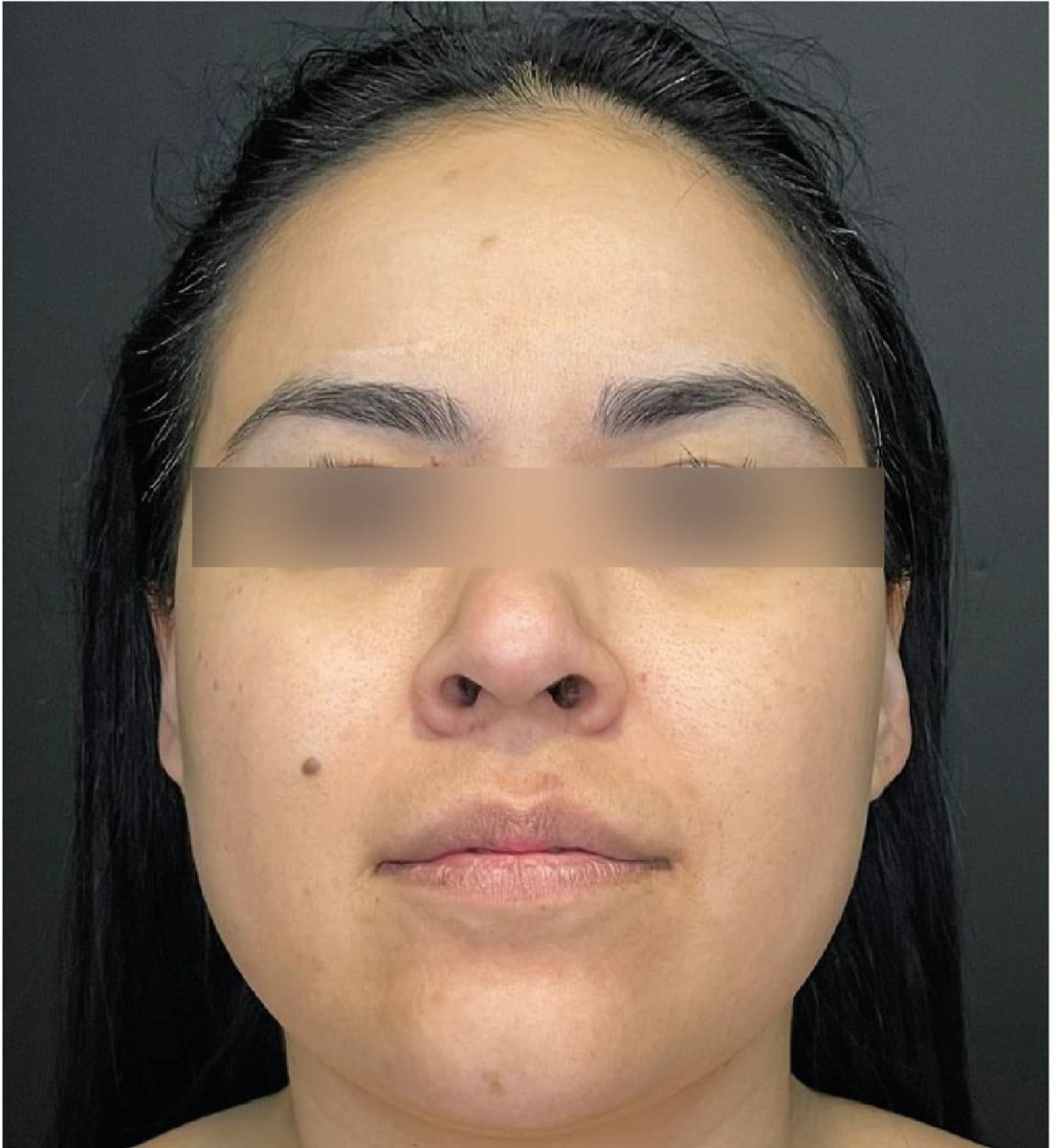 Neck liposuction and buccal fat removal: before