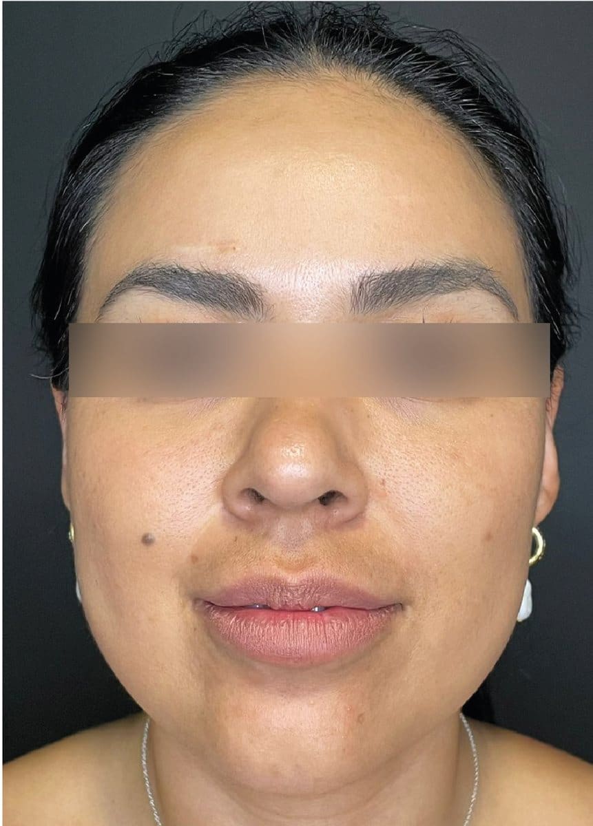 Neck liposuction and buccal fat removal: after