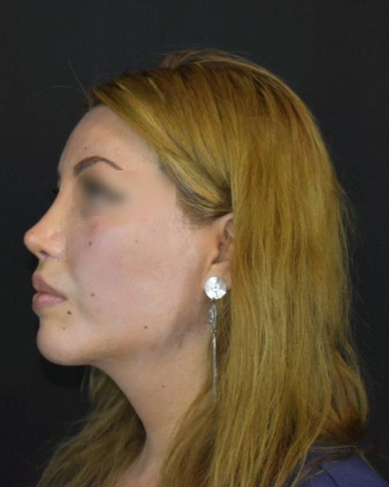 Rinoplastia, perfil: antes