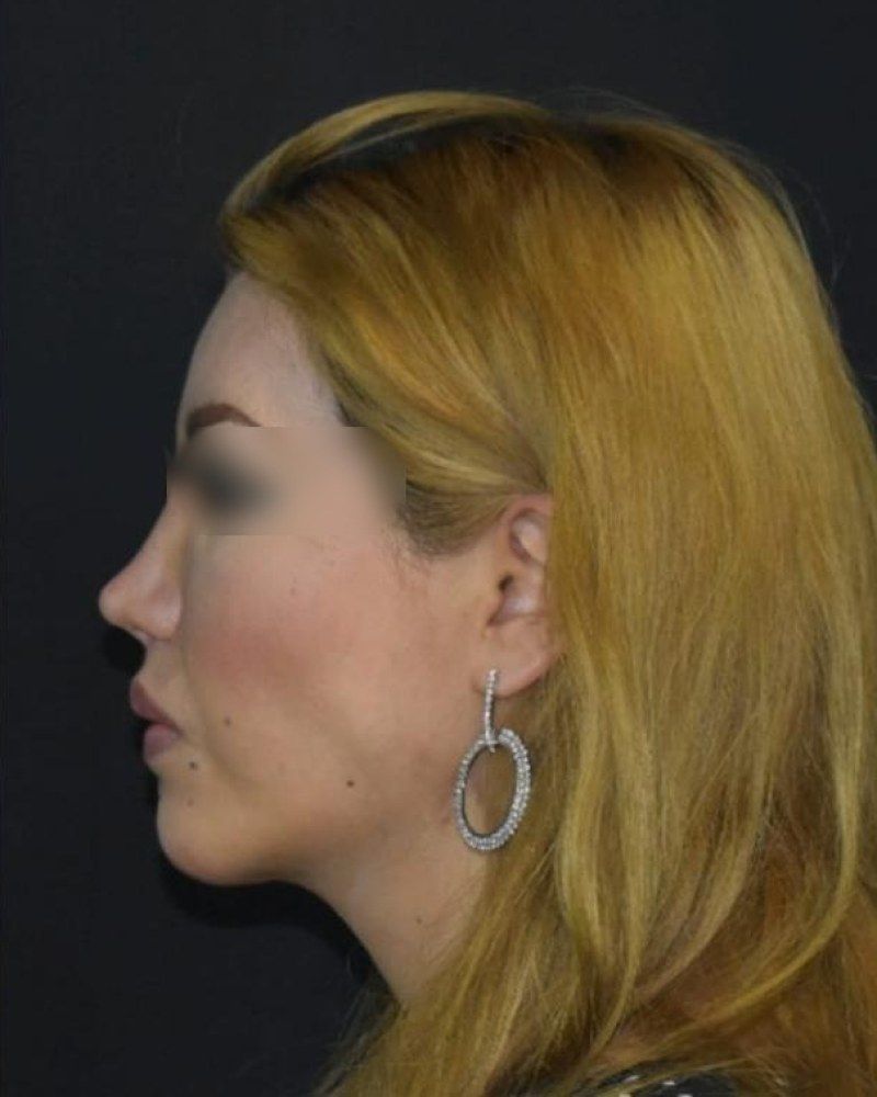 Rinoplastia, perfil: después
