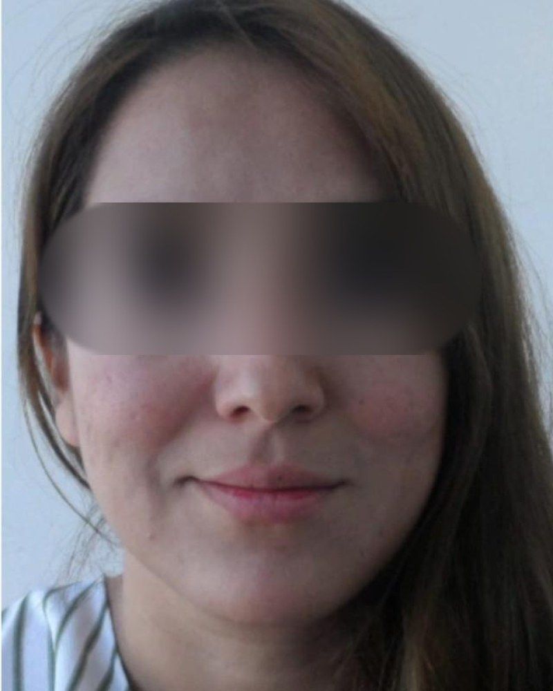Rinoplastia, frente: antes