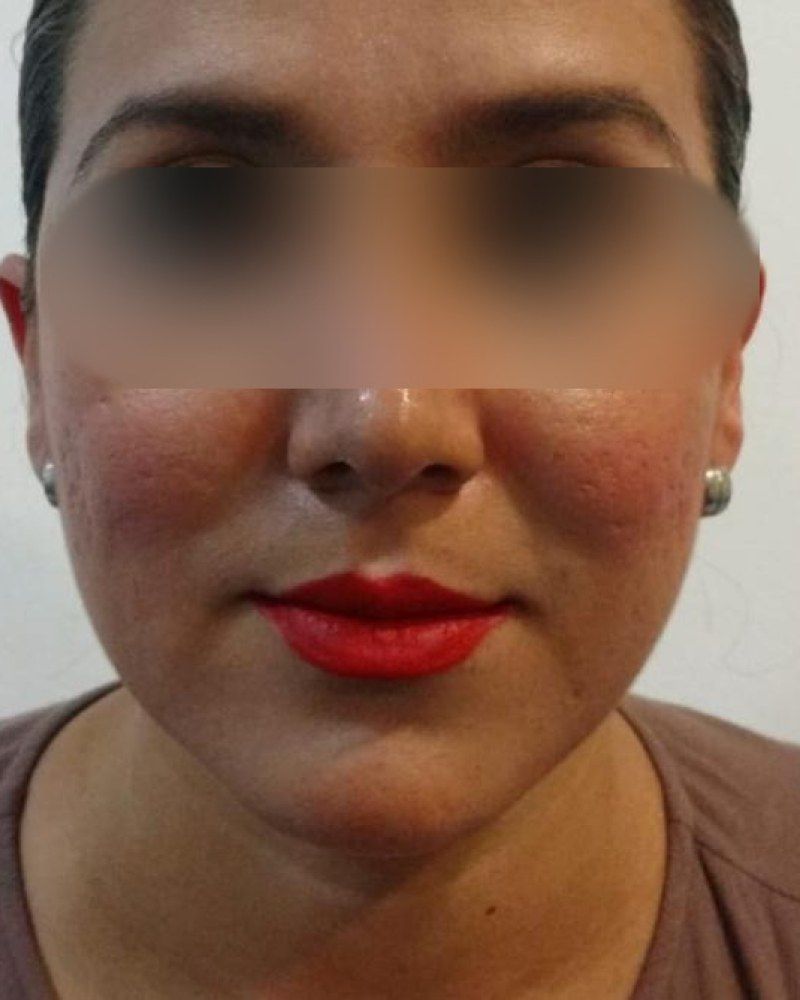 Rinoplastia, frente: después