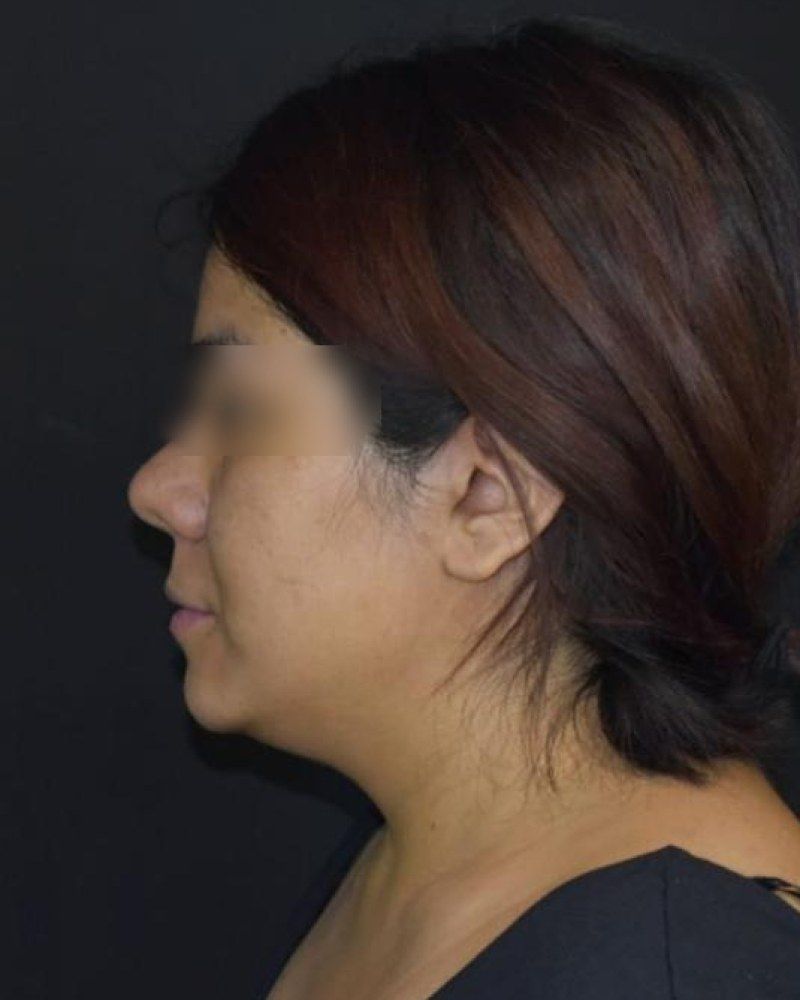 Rinoplastia, perfil: antes