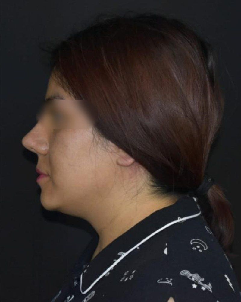Rinoplastia, perfil: después