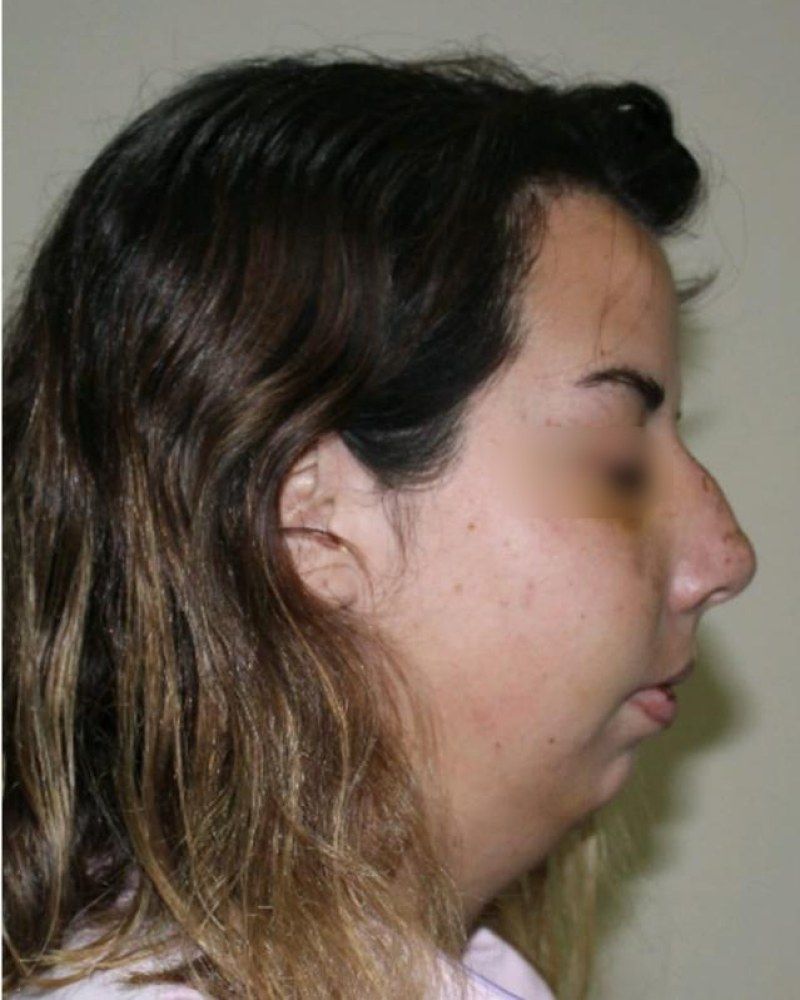 Rinoplastia, otro perfil: antes