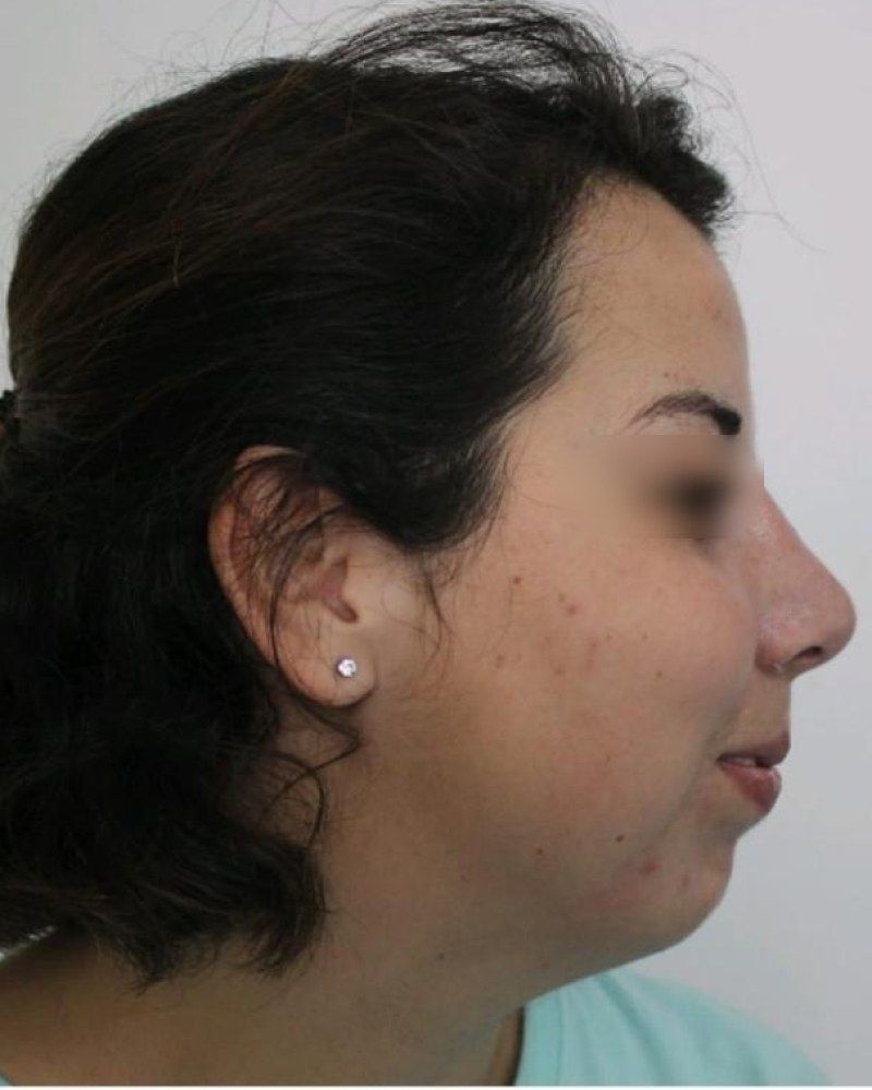 Rinoplastia, otro perfil: después