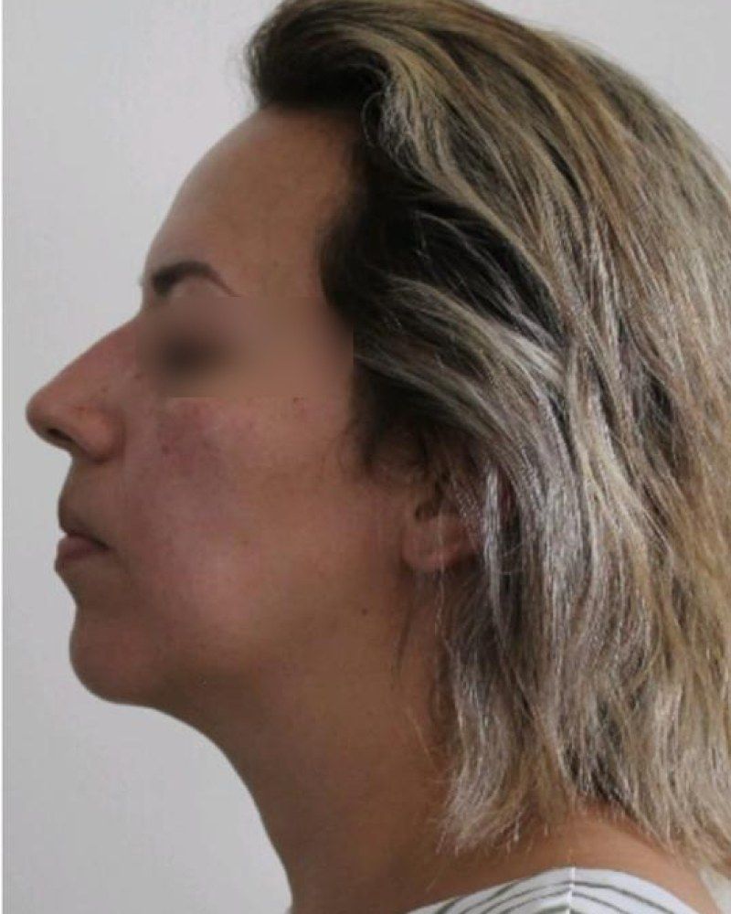 Rinoplastia, perfil: antes