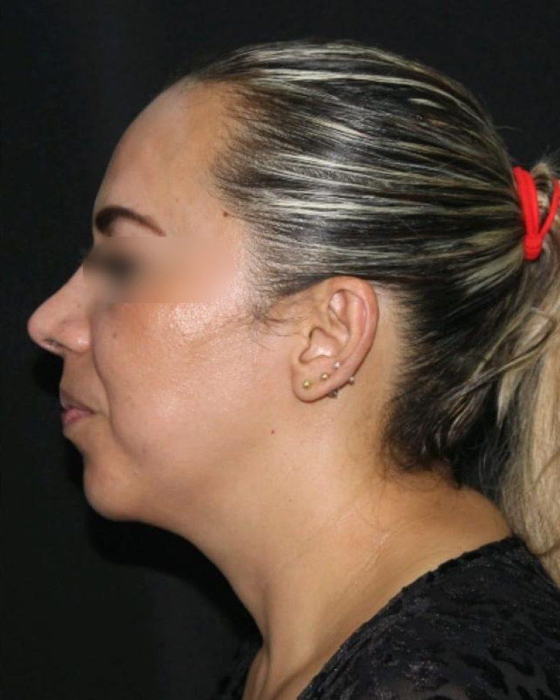 Rinoplastia, perfil: después