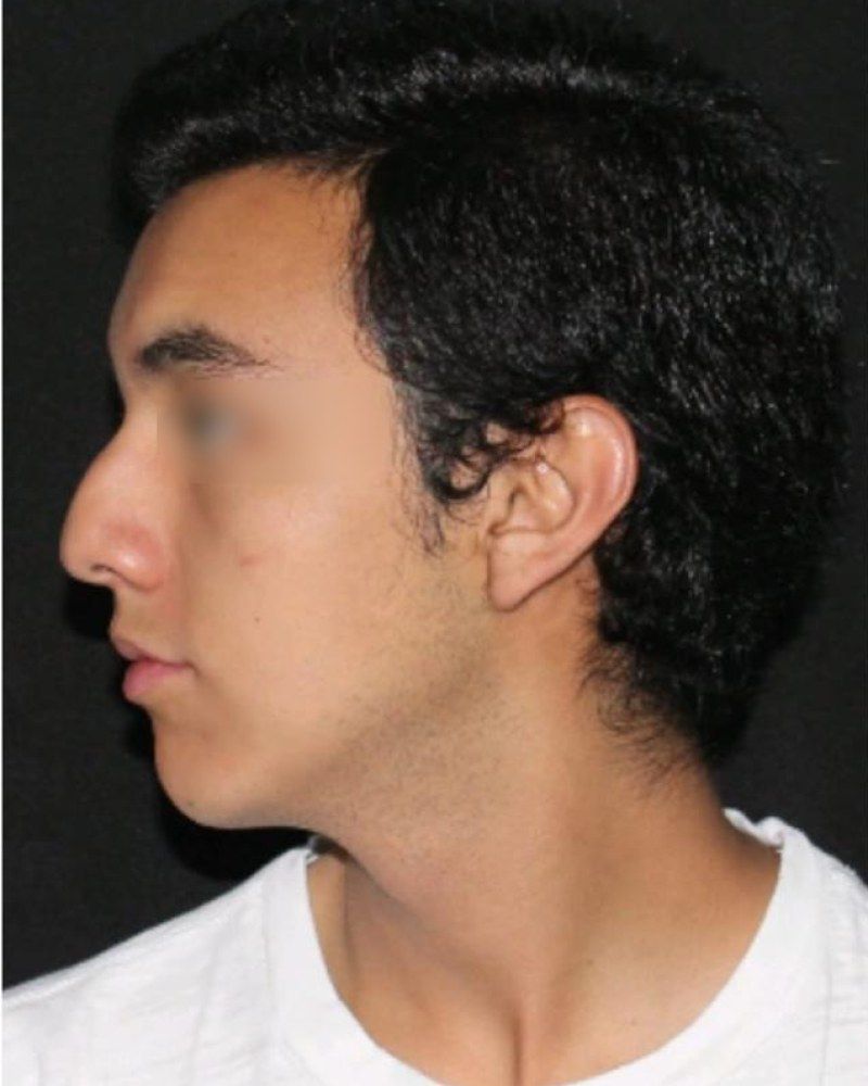Rinoplastia, perfil: antes