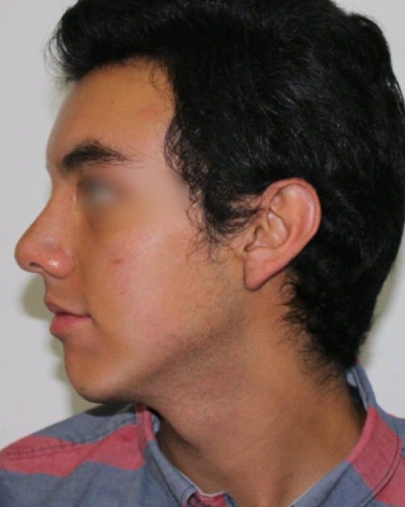 Rinoplastia, perfil: después
