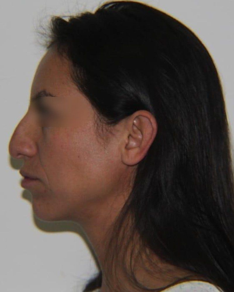 Rinoplastia, perfil: antes