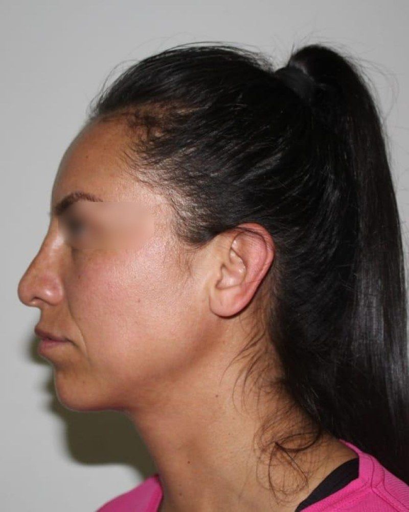 Rinoplastia, perfil: después