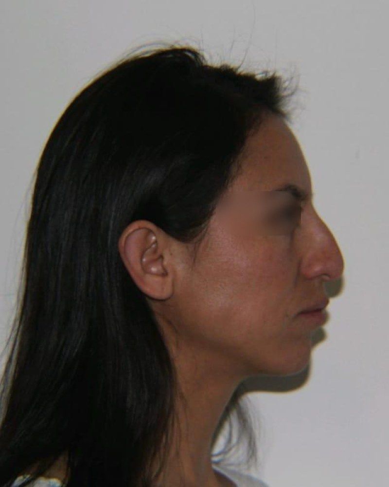 Rinoplastia, perfil: antes