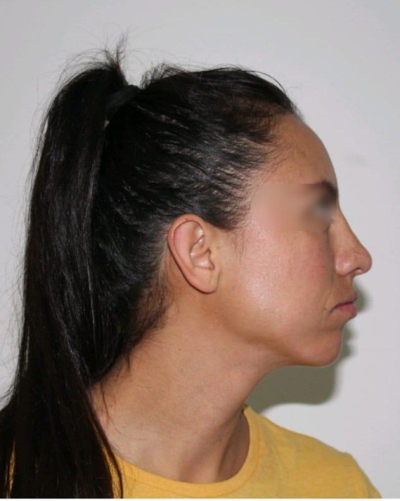 Rinoplastia, perfil: después