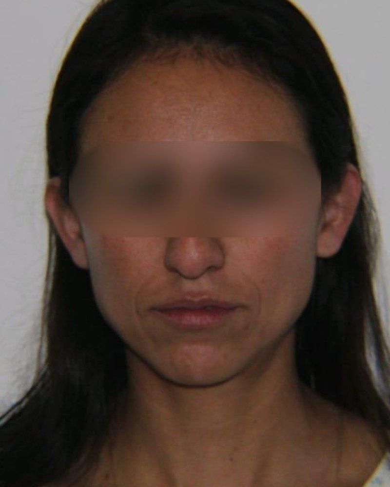 Rinoplastia, frente: antes