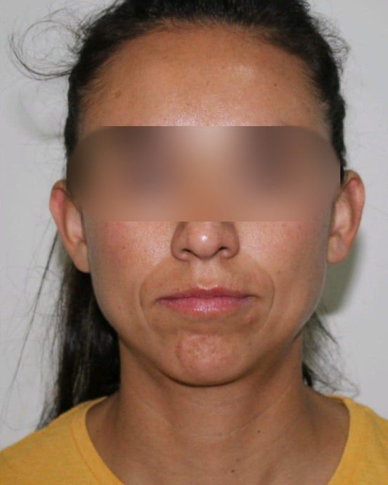 Rinoplastia, frente: después