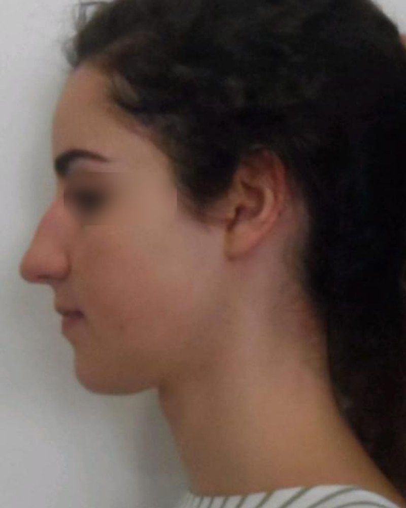 Rinoplastia, perfil: antes