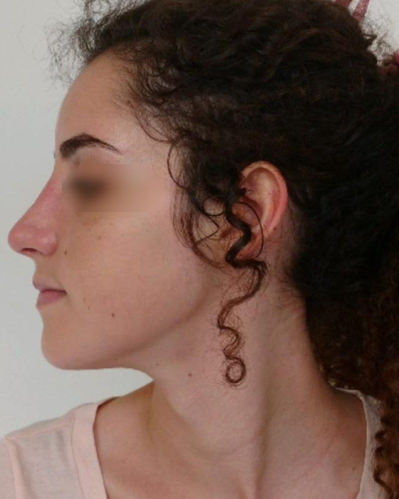 Rinoplastia, perfil: después