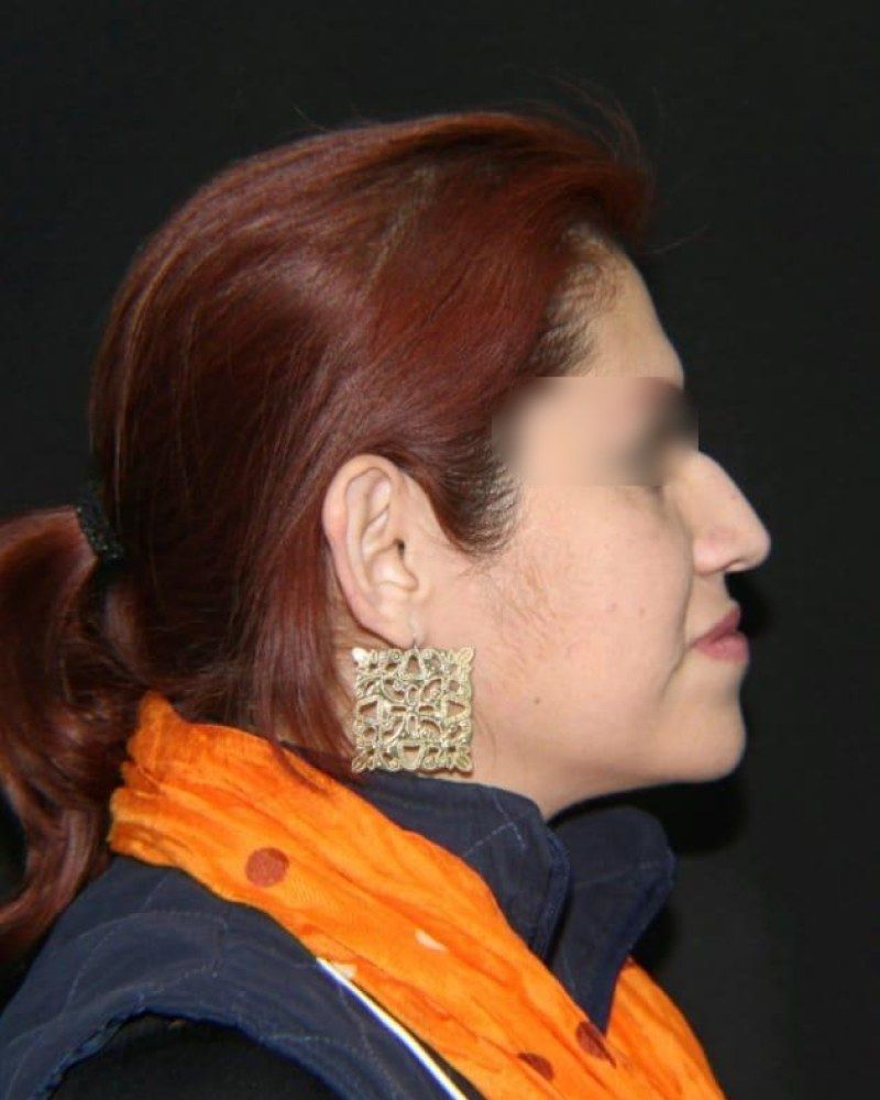 Rinoplastia, perfil: antes