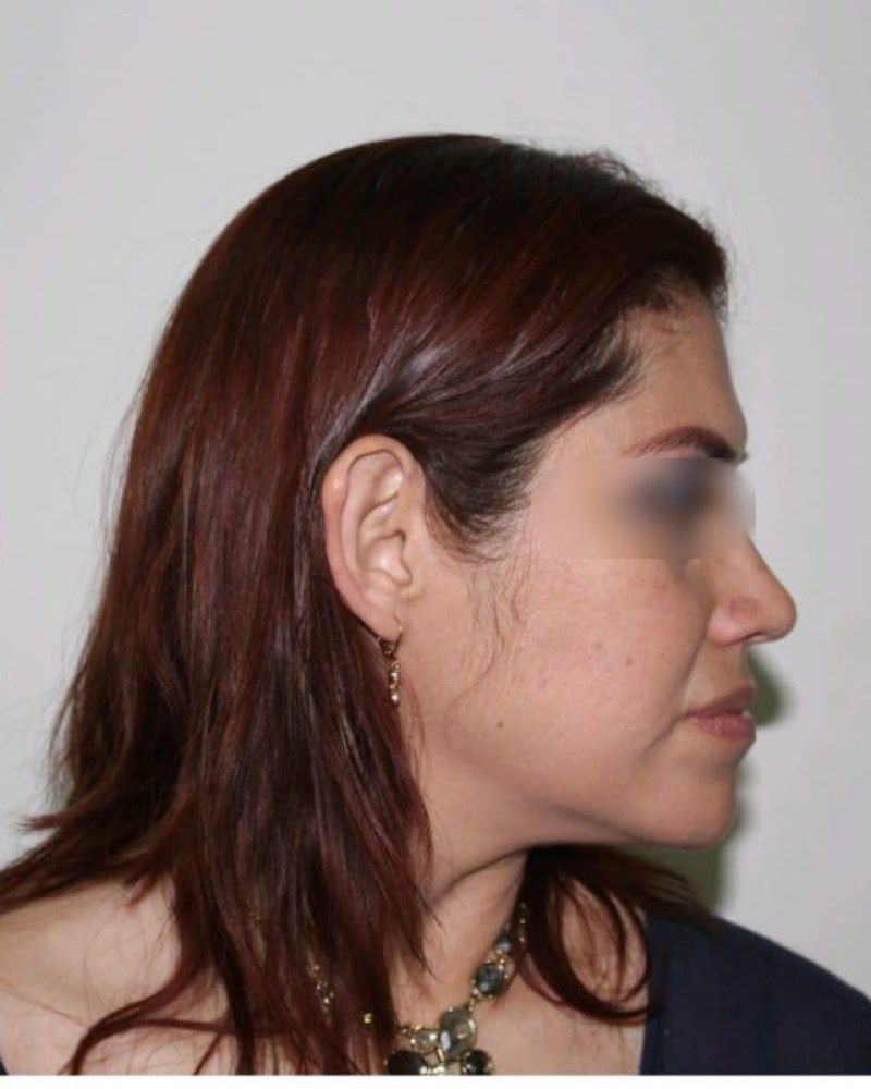 Rinoplastia, perfil: después
