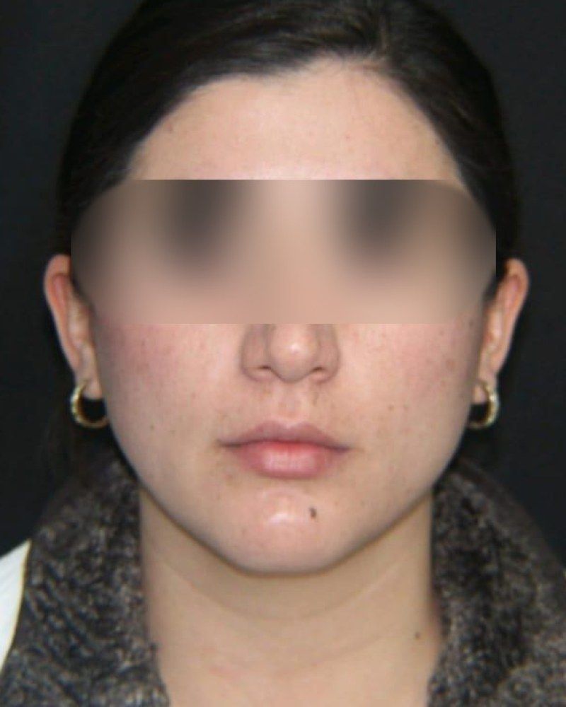 Rinoplastia, frente: antes