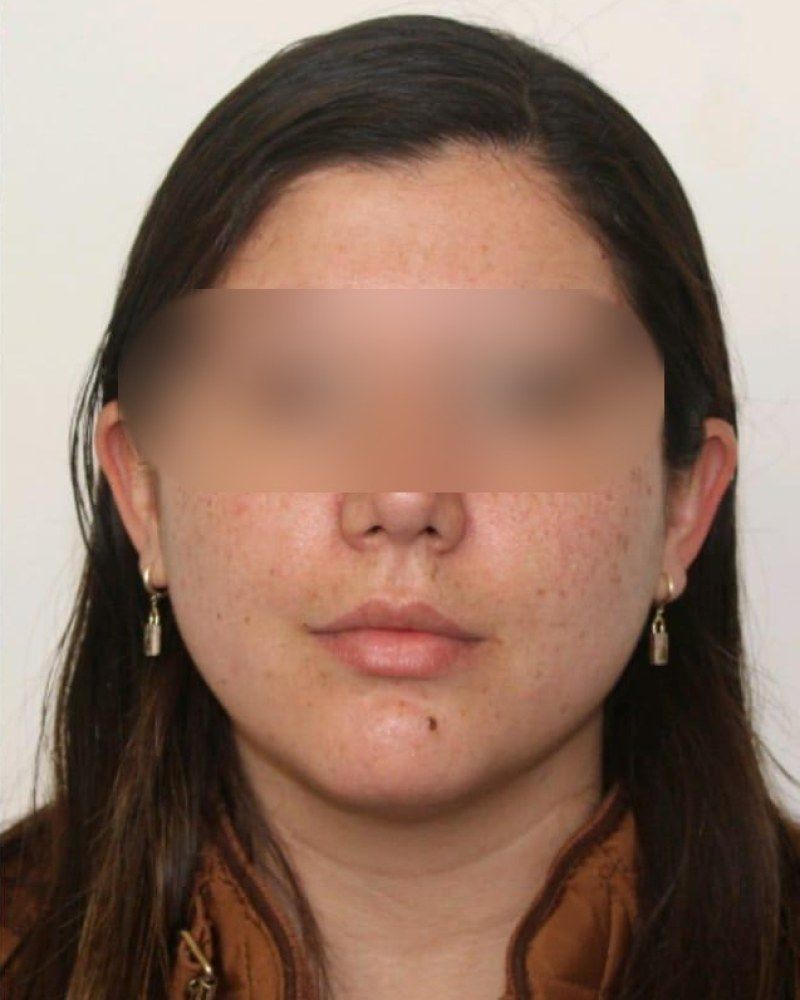 Rinoplastia, frente: después
