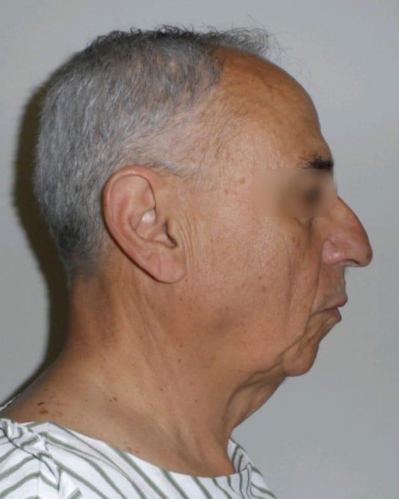 Lifting facial, perfil: antes