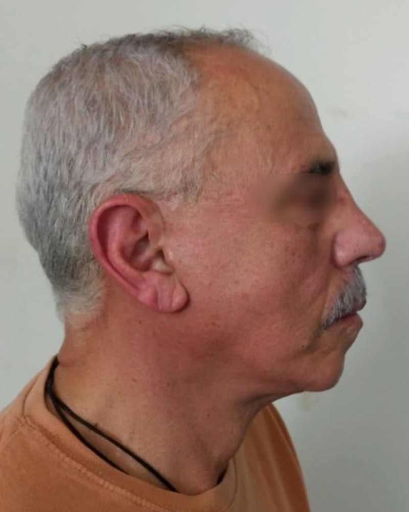 Lifting facial, perfil: después