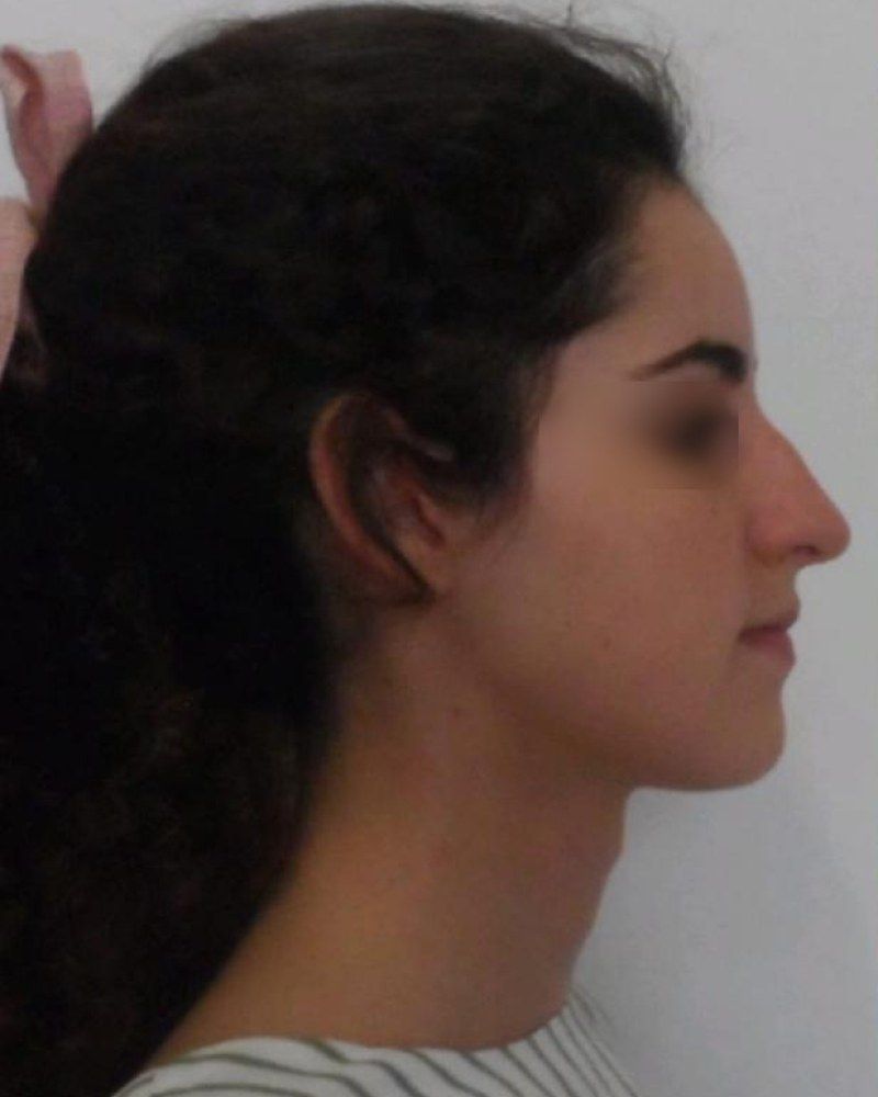 Rinoplastia, otro perfil: antes