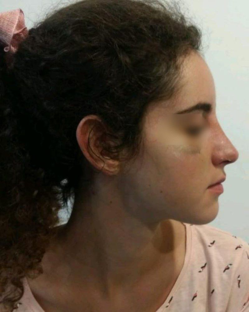 Rinoplastia, otro perfil: después