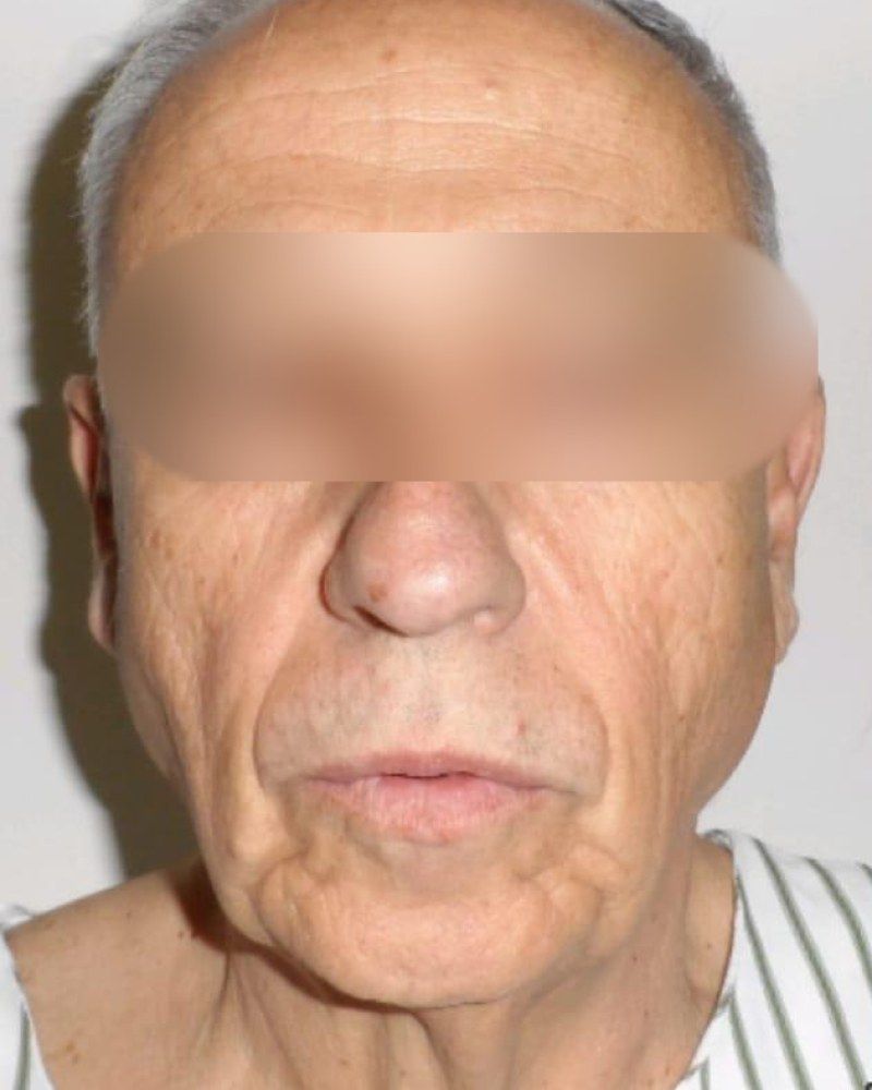 Lifting facial, frente: antes