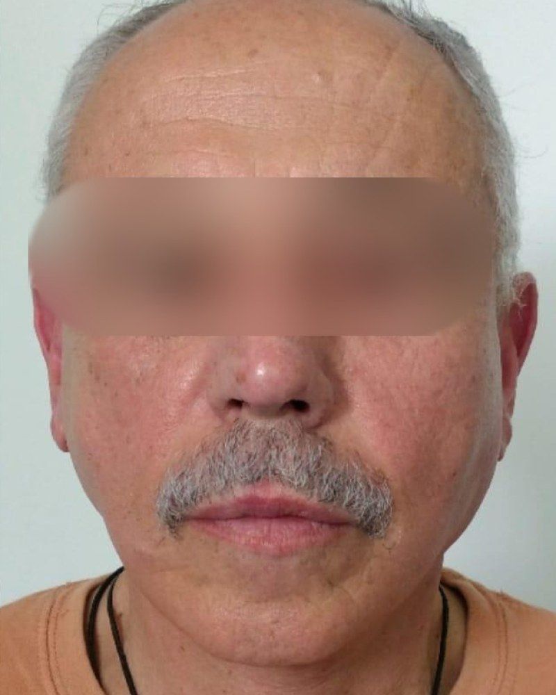 Lifting facial, frente: después