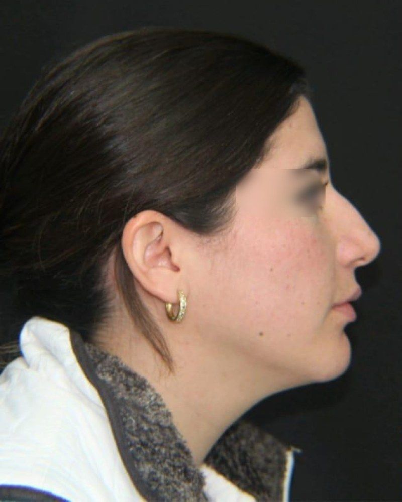 Rinoplastia, perfil: antes