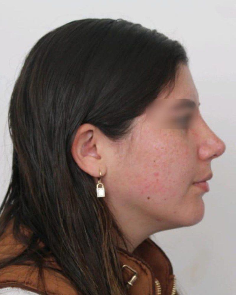 Rinoplastia, perfil: después