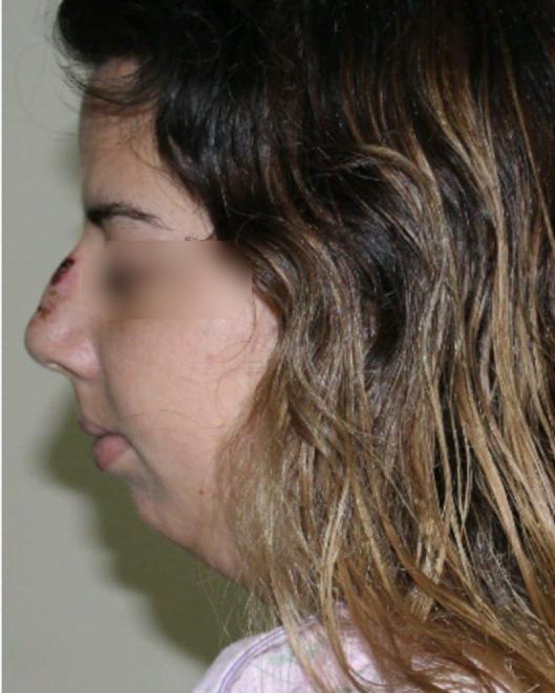 Rinoplastia, perfil: antes