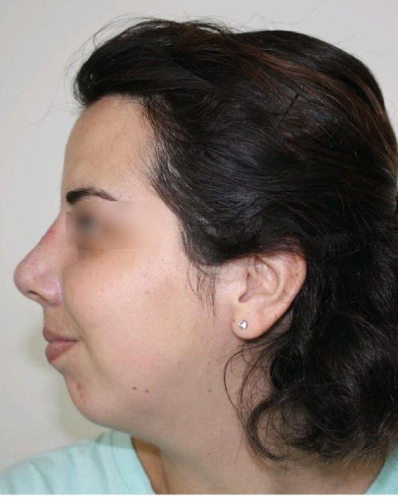 Rinoplastia, perfil: después